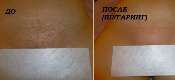 Шугаринг глубокое бикини женщинам: что такое и как делают